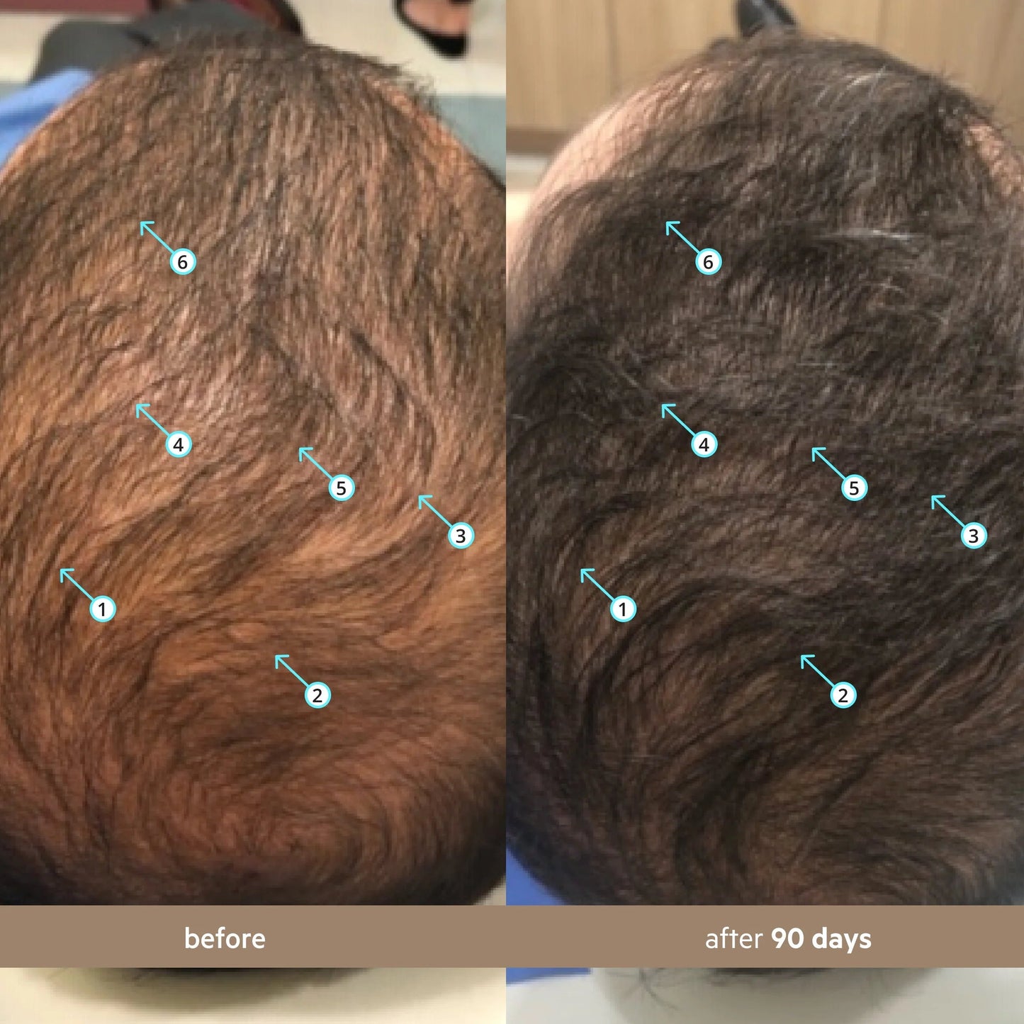 🏅AQANanoxidil 5% Hair Growth Serum for Thicker, Fuller Hair☘️
